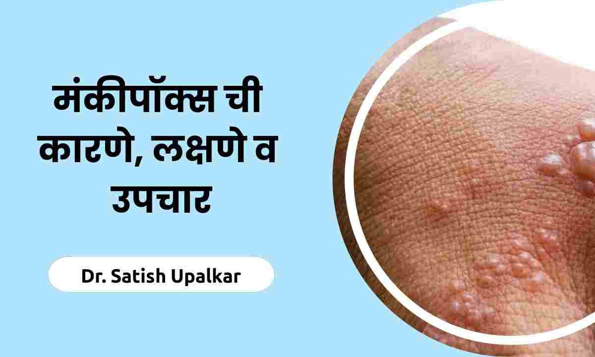 Causes, Symptoms, Treatments & Meaning of Monkeypox In Marathi by Dr Satish Upalkar.