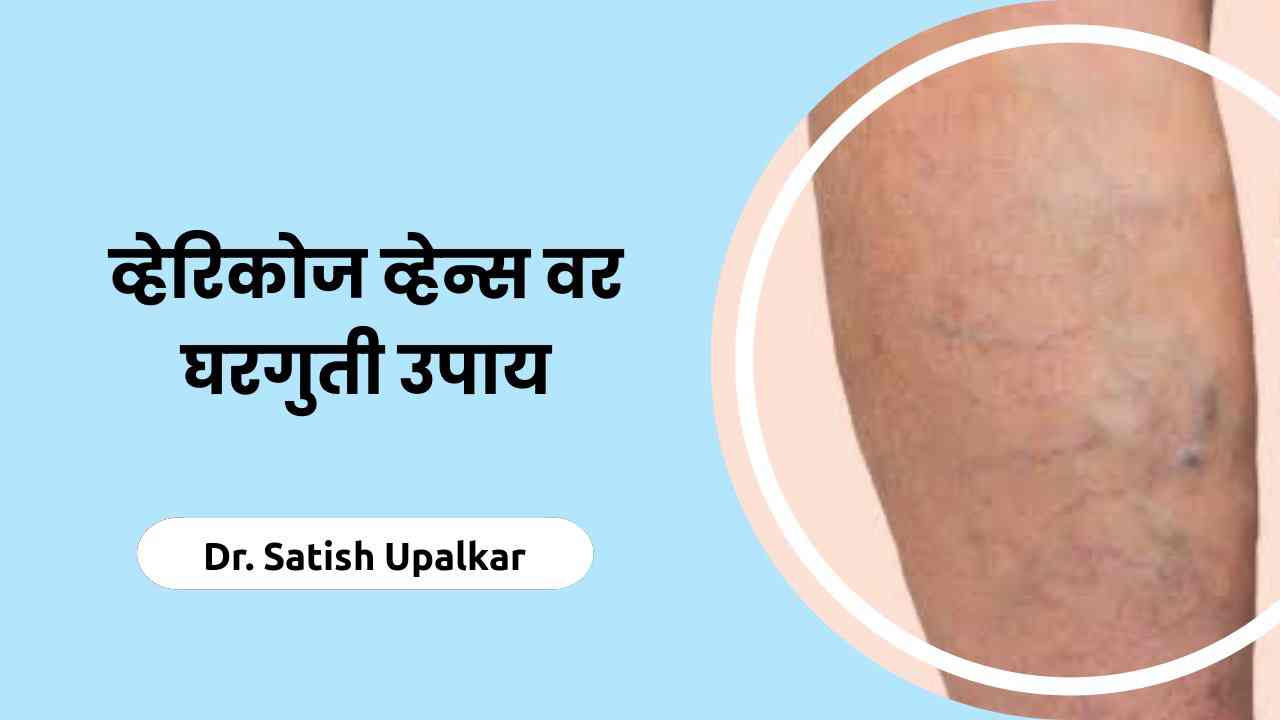  home remedies for varicose veins article by Dr Satish Upalkar.